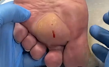 Treatment of unexpected foot abscess discharge is focused on preventing scarring and recurrence.