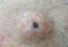 The Biggest Dilated Pore of Winer?! THERAPY Biggest Dilated Pore avoiding reoccurring and leaving scars