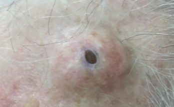 The Biggest Dilated Pore of Winer?! THERAPY Biggest Dilated Pore avoiding reoccurring and leaving scars